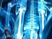 OSTÉOPOROSE Pourquoi néglige trop santé