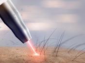 MALADIE PILONIDALE faveur l’épilation laser