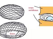 Soigner hernies discales: idées d'un physicien