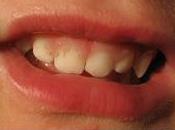 Orthopédie dento-faciale orthodontie