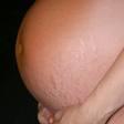 Traitement vergeture pendant grossesse