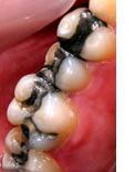 Désinformation amalgames dentaires perdraient long terme leur pouvoir toxique