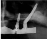 Implants zygomatiques autres implants dentaires maxillo-faciaux