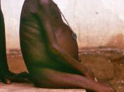 L'IMAGE JOUR: Jeune fille atteinte kwashiorkor