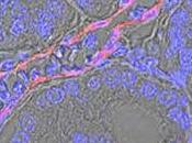 MEDECINE: Découverte d'un marqueur biologique impliqué dans sortes cancers