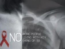 VIH-TB VIVRE avec mourir tuberculose, c’est évitable ONUSIDA