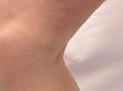 Quelles sont causes varices?