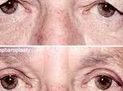 Blépharoplastie chirurgie yeux