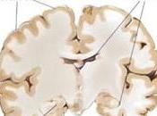 ALZHEIMER: stimulation cérébrale profonde pour retrouver mémoire? NEJM