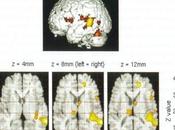 L´implication système limbique dans perception acouphénique