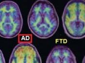 Test ALZHEIMER: composé radioactif pour repérer plaques amyloïdes American Academy Neurology annual meeting