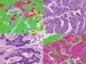 CANCER SEIN: types tumeurs, vers pronostic traitement personnalisés Nature
