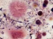 VACHE FOLLE: Découverte d’une nouvelle voie d’infection moelle épinière American Journal Pathology