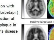 Diagnostic l’ALZHEIMER: radiomarqueur plaque amyloïde recommandé EMA-CMPH