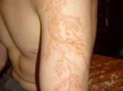 figures Lichtenberg: comment foudre peut tatouer fractales votre peau!