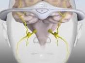 MIGRAINE: serre-tête bloque douleur Neurology