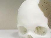 prothèse crânienne impression