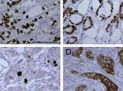 Pertuzumab, trastuzumab, docetaxel pour traitement cancer sein métastatique HER2-positif (Étude CLEOPATRA): résultats globaux survie d’une étude phase randomisée, double aveugle contrôlée placebo