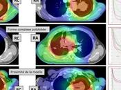 Critères substitution pour l’évaluation survie lors essais chimiothérapie radiothérapie dans cancer poumon opérable localement avancé: nouvelle analyse méta-analyses données individuelles patients
