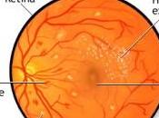 AVC: Votre risque rien dans yeux Hypertension