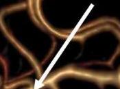 FEMME +TABAC HTA: Risque d'hémorragie cérébrale mortelle multiplié PLoS