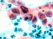 VACCIN anti-HPV: seule dose pourrait suffire Cancer Prevention Research