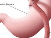 CHIRURGIE BARIATRIQUE: Avec poids, perd parfois goût l'odorat Obesity Surgery