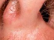 Thérapie faisceau particules chargées versus photonthérapie pour maladies malignes sinus paranasal fosse nasale