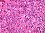 Combinaison d’ibrutinib avec rituximab, cyclophoshamide, doxorubicine, vincristine, prednisone (R-CHOP) chez patients atteints d’un lymphome hodgkinien cellules CD20 positif, n’ayant reçu traitement préalable: étude pha...