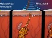 ACNÉ: Nanoparticules ultrasons pour traitement local puissant Journal Controlled Release