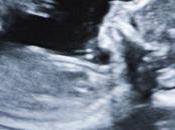 Lors d’une radiographie hanche elle découvre fœtus momifié