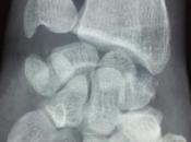 Image luxation fracture transscapho-rétrolunaire