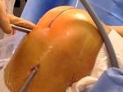 causes d’échec chirurgie ligament croisé antérieur (LCA)