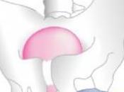 CHIRURGIE l'INCONTINENCE d'effort: Quelle meilleure voie? Cochrane Library