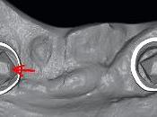 Scanners intra-oraux fiables pour réalisation barres implantaires