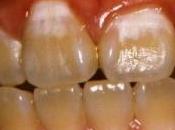 CARIE DENTAIRE: Traiter sans fraiser Community Dentistry Oral Epidemiology