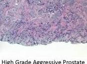 CANCER PROSTATE: promesses thérapie génique gène suicide Journal Radiation Oncology