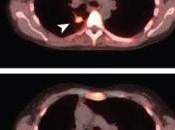 CANCERS sein, poumon, mélanome palbociclib réduit croissance tumorale JAMA Oncology