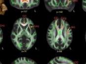 AUTISME: différences cérébrales subtiles identifiées chez hommes atteints Brain