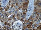 #thelancetoncology #CBNPC #dabrafenib #BRAFkinase #BRAFV600E Dabrafenib chez patients atteints cancer poumon petites cellules avancé BRAFV600E-positif étude multicentrique phase simple bras