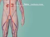 #thelancet #événementscardiovasculaires #excrétionurinairedesodium Association entre excrétion urinaire sodium évènements cardiovasculaires chez sujets avec sans hypertension analyse données mutualisées issues quatre études