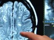 ALZHEIMER: maladie vasculaire cérébrale, facteur très sous-estimé Lancet Neurology