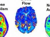 ALZHEIMER: tout premier signe, apport réduit sang cerveau Nature Communications