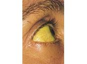 peau bronzee maladie