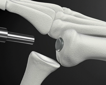 ARTHROSE: Premier implant du cartilage synthétique approuvé aux USA – Santé Orthopédique