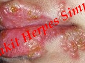 obat herpes zoster bagi hamil