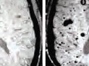 MICROBIOTE INTESTINAL influe vaisseaux cerveau jusqu'au risque d'AVC Nature