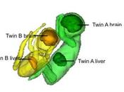 JUMEAUX Mais pourquoi l'un est-il plus petit l'autre Scientific Reports