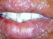 obat herpes bibir alami