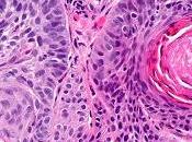 #thelancetoncology #carcinome #trastuzumabderuxtecan #activitéantitumorale Innocuité, pharmacocinétique, activité antitumorale trastuzumab deruxtecan (DS-8201), conjugué d’anticorps-médicament ciblant HER2, chez patients atteints tumeur...